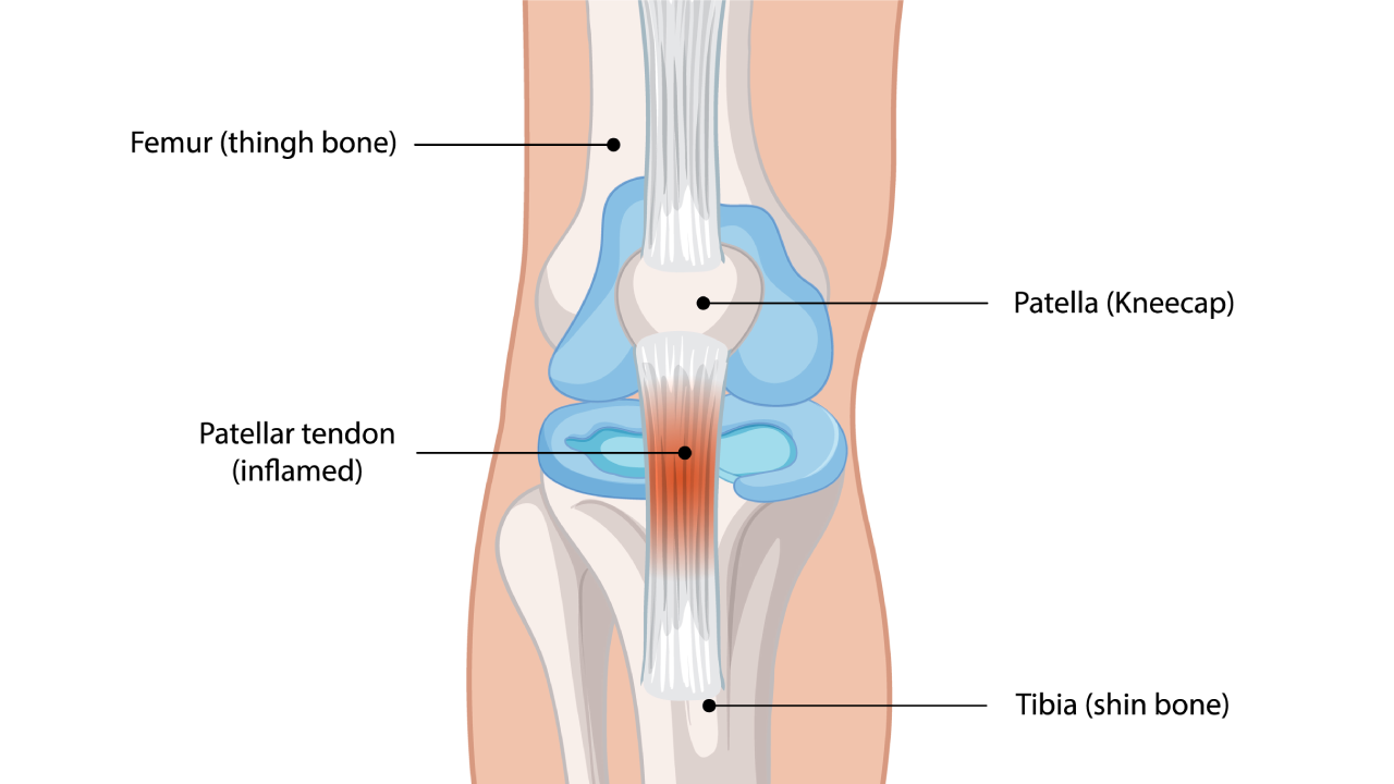 Knee Tendinitis