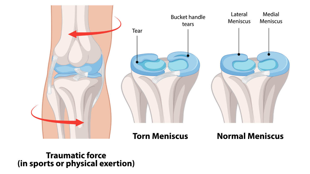 Meniscus Injuries