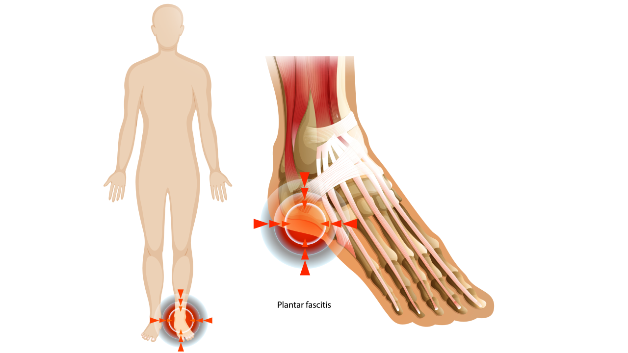 Plantar Fasciitis