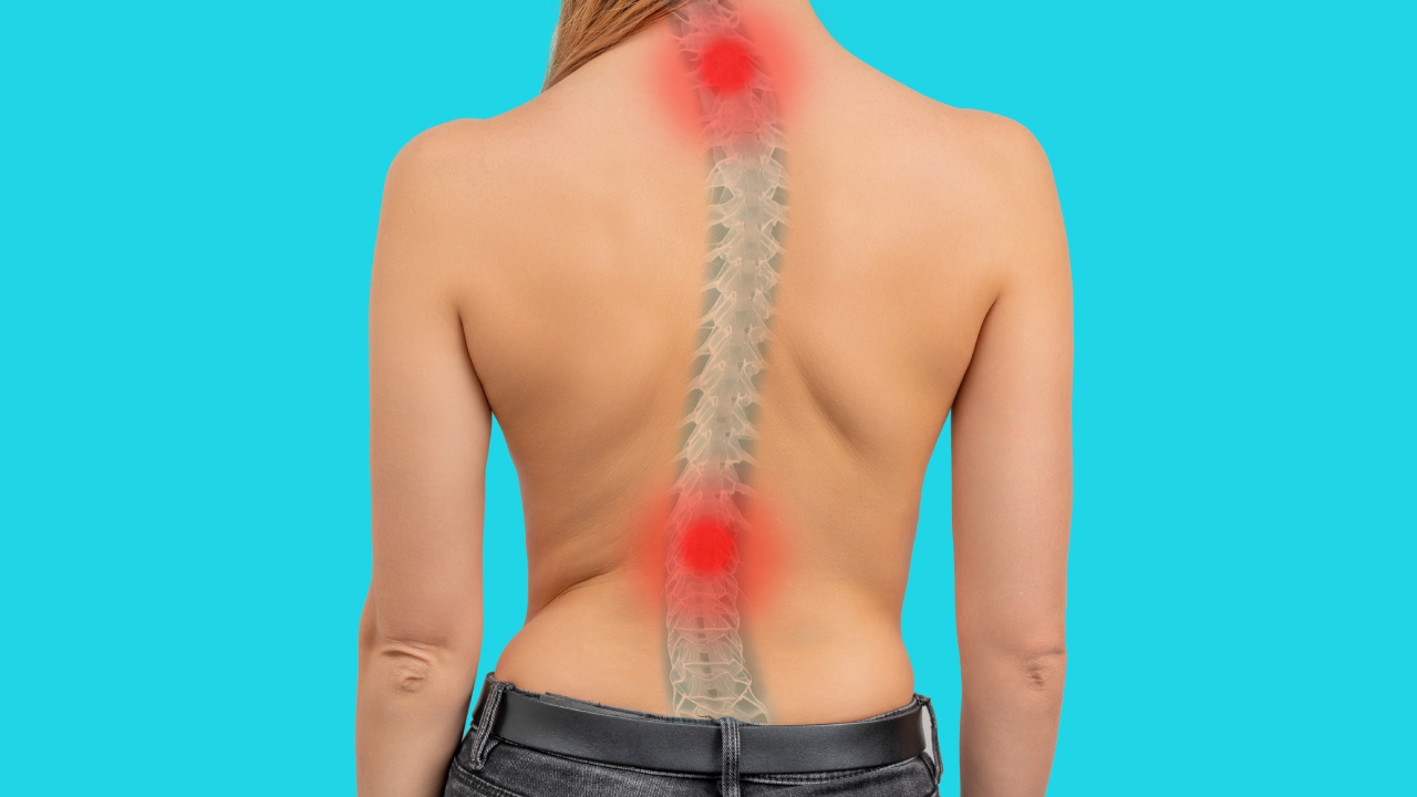 Scoliosis