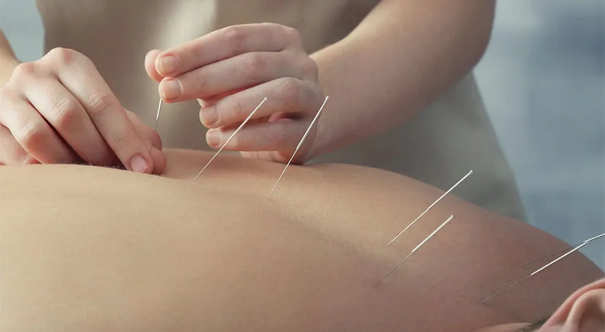 Acupuncture treatment