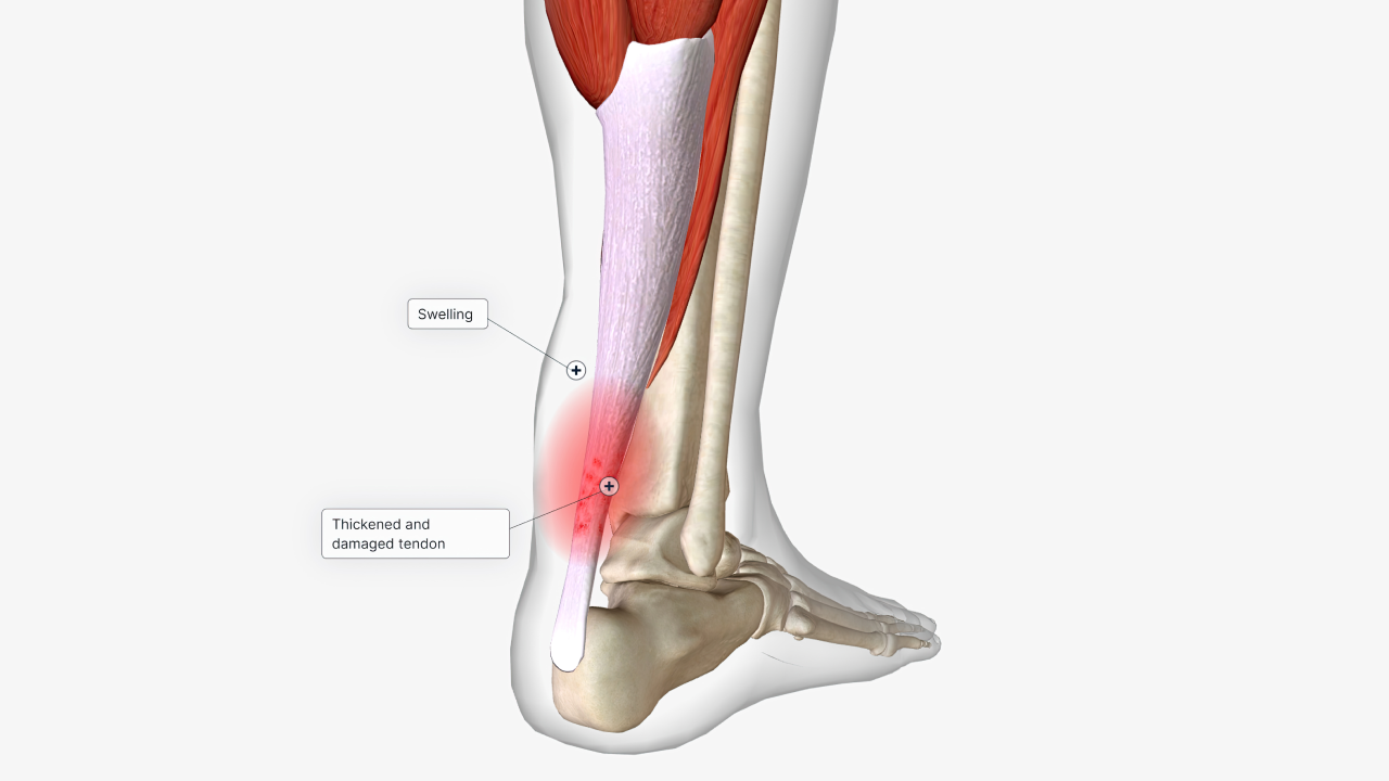 Achilles Tendon Injuries