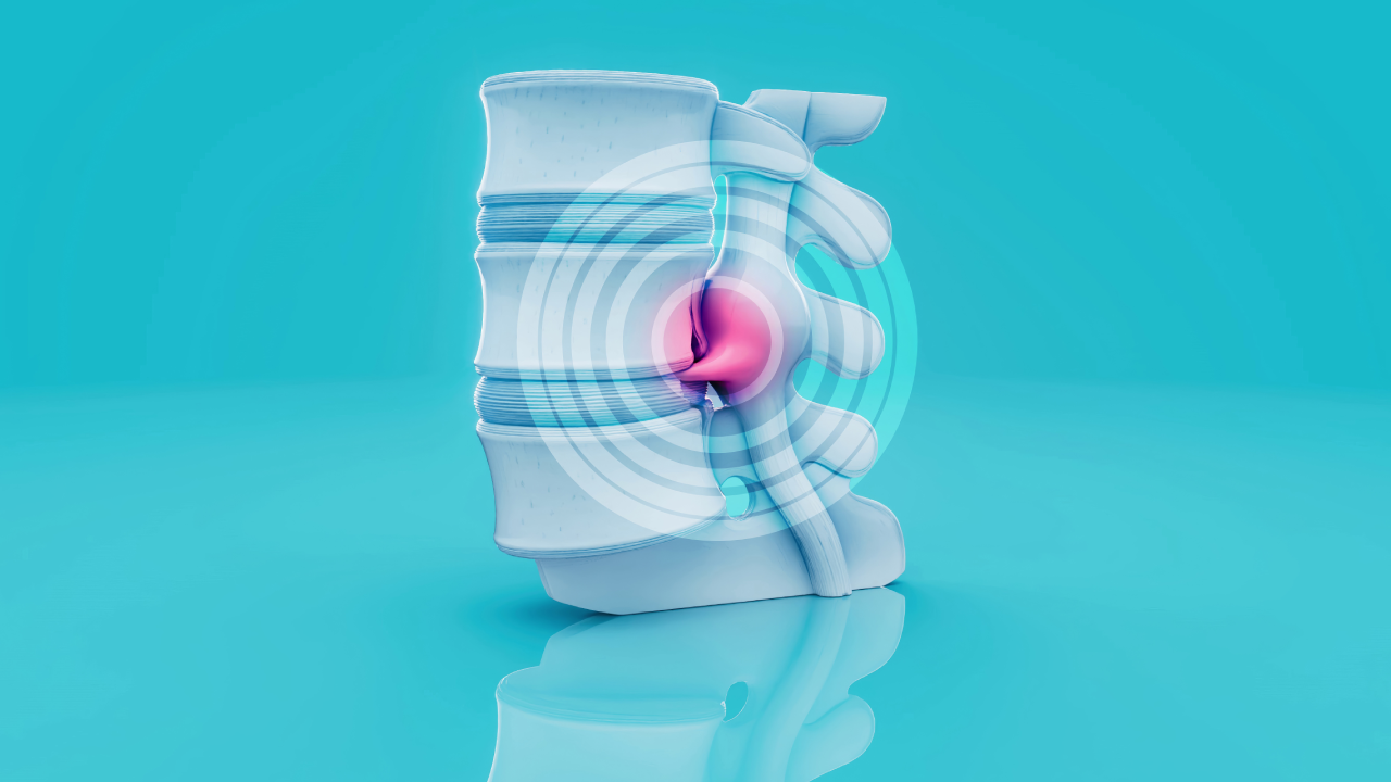 Bulging Disc