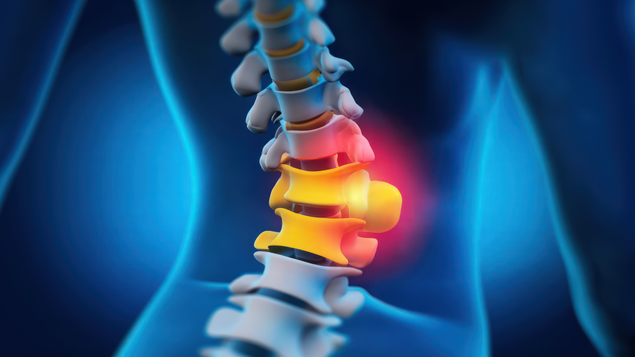 Herniated Disc