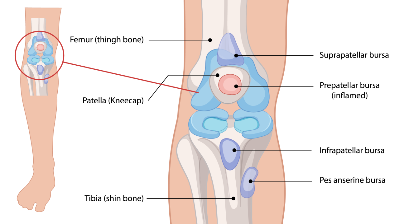 Knee Bursitis