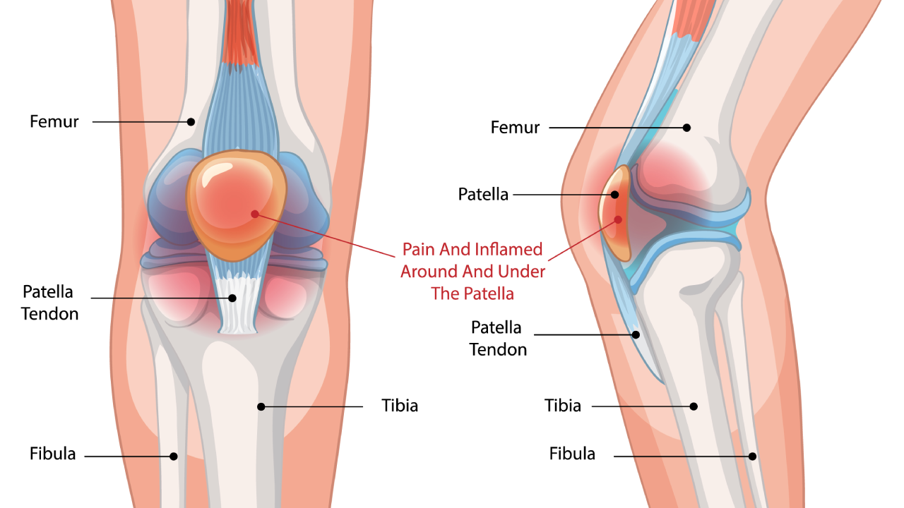 Patellofemoral Pain Syndrome