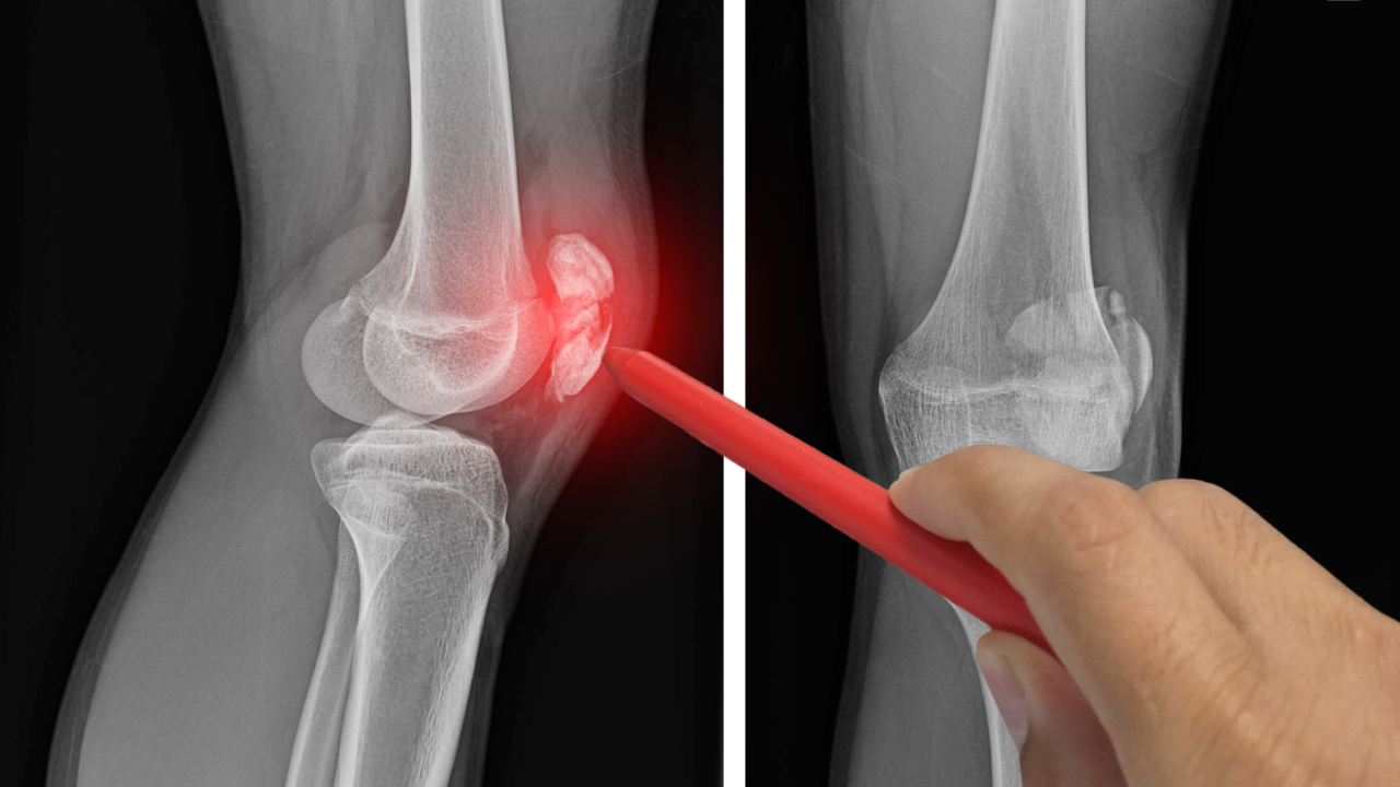 Runner’s Knee